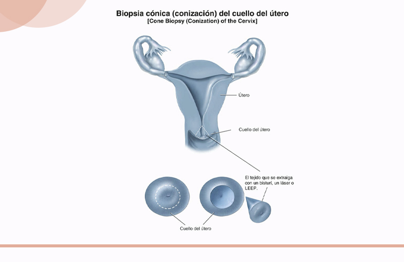 tratamiento cono leep dr francisco lopez