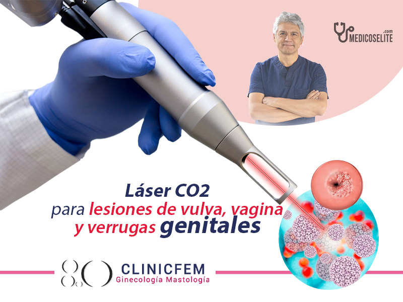 tratamiento-papiloma-quito-con-laser